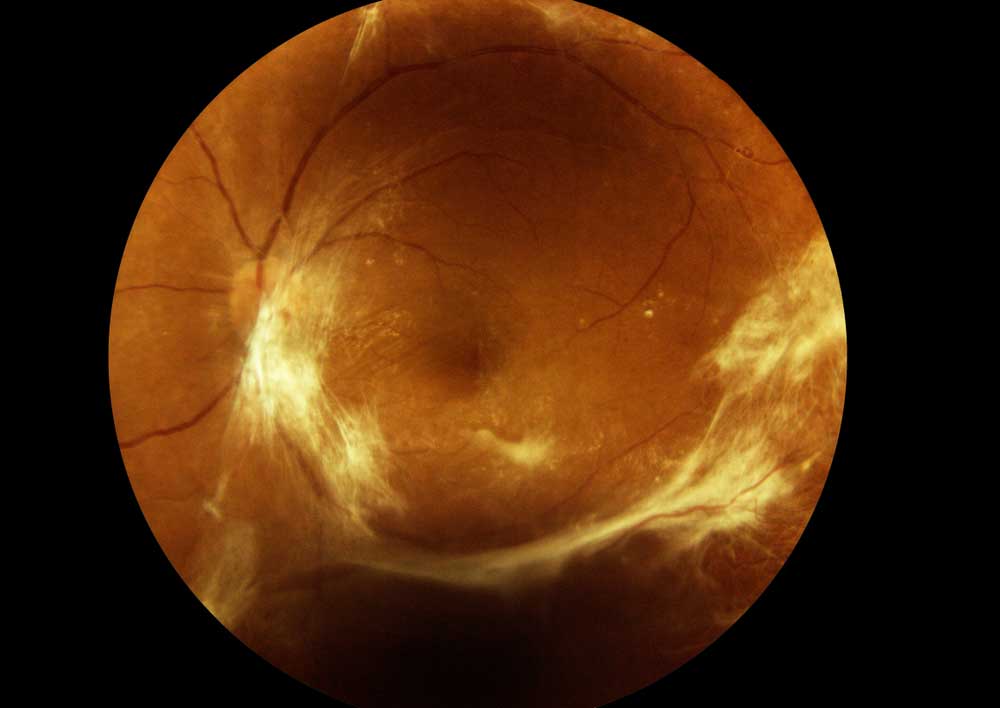 Epiretinal Membran