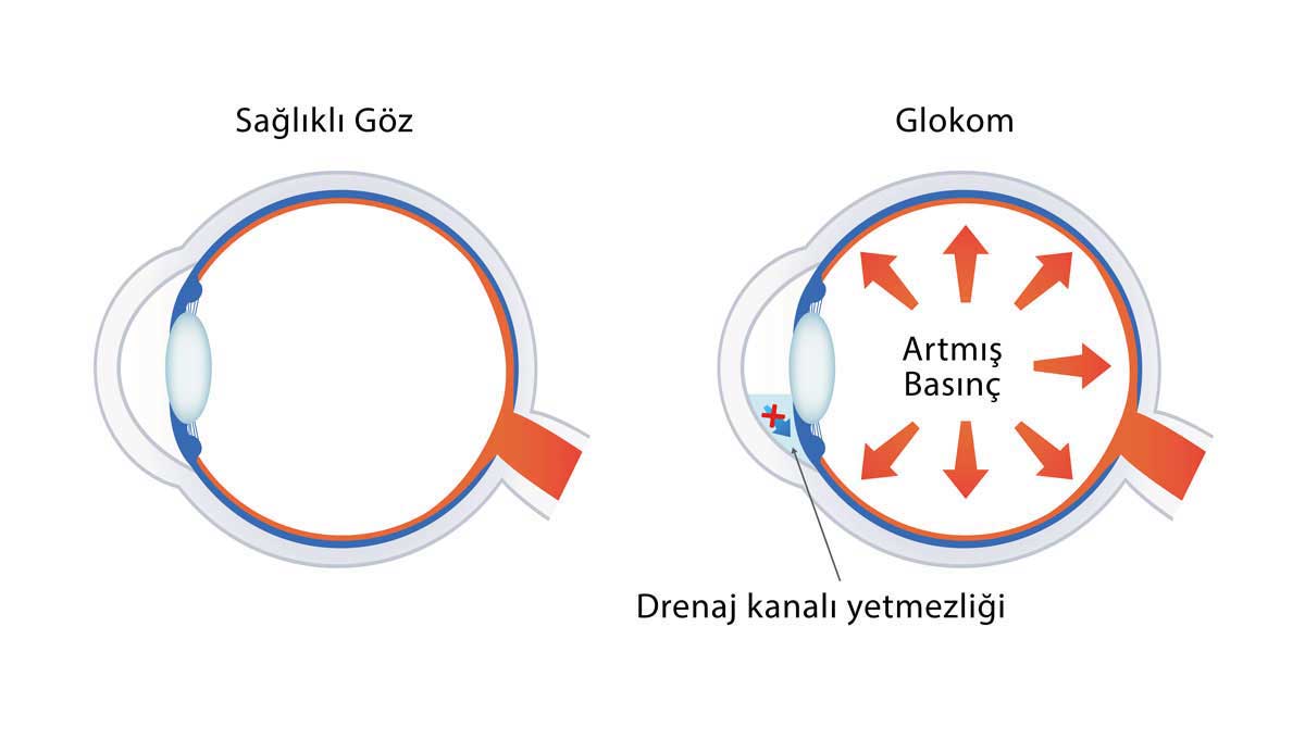 Fakomorfik glokom-Açı Kapanması Glokomu