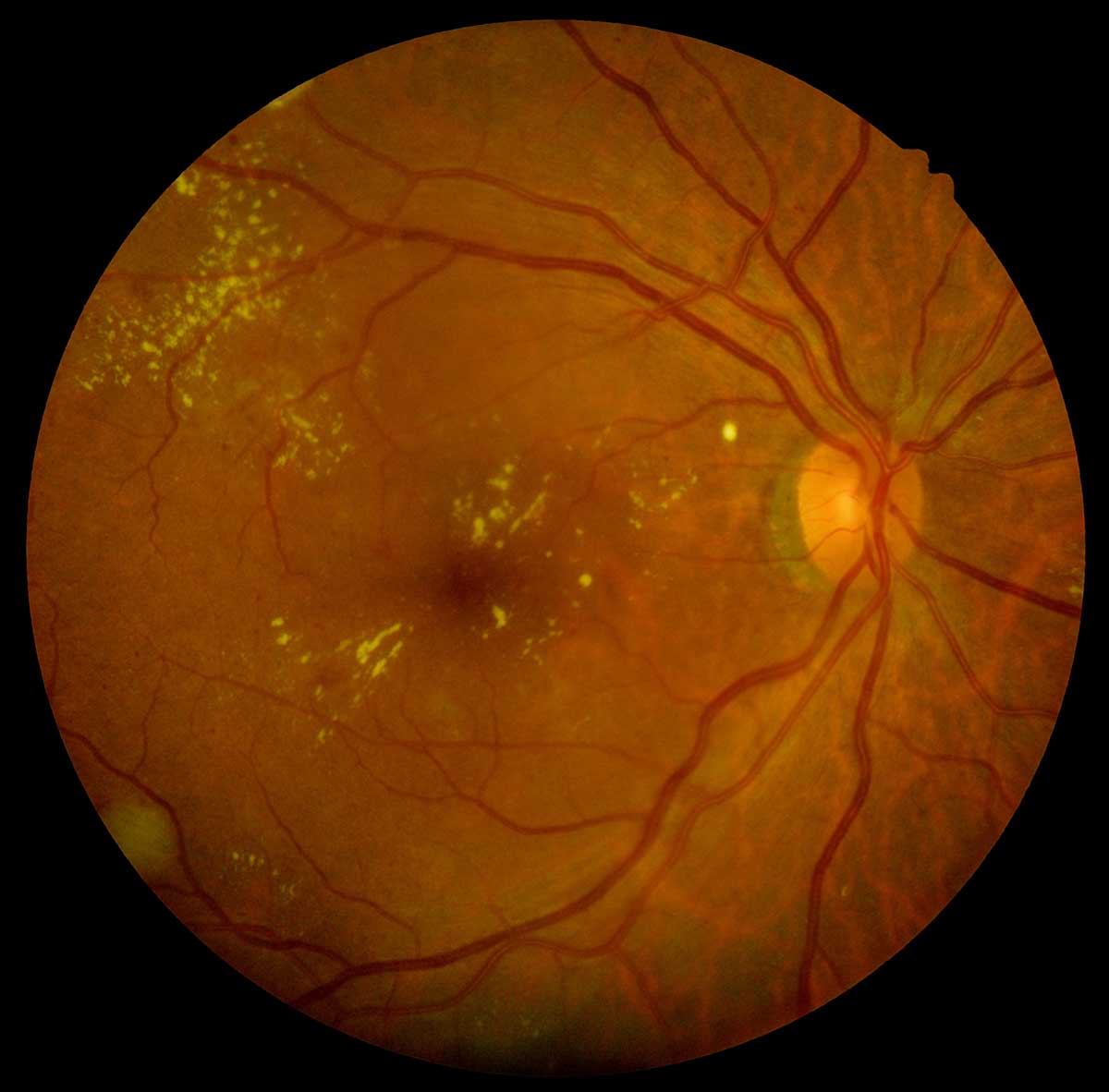 Göz Arkası Ödemi-Diyabetik Maküla Ödemi-Diyabetik Retinopati