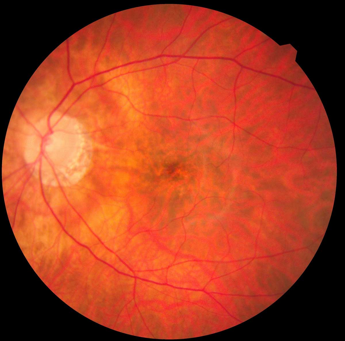 Göz Dibi Muayenesi, Retina