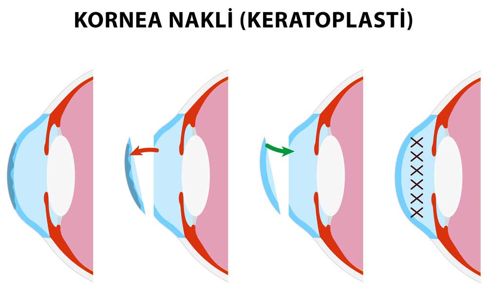Keratoplasti-Kornea Nakli