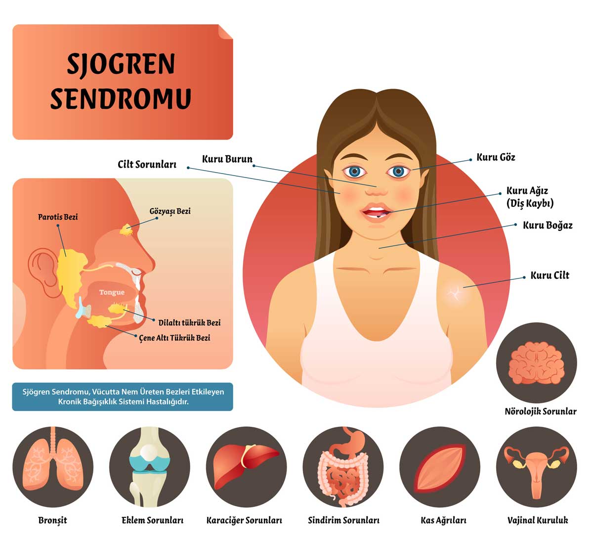 Sjogren Sendromu