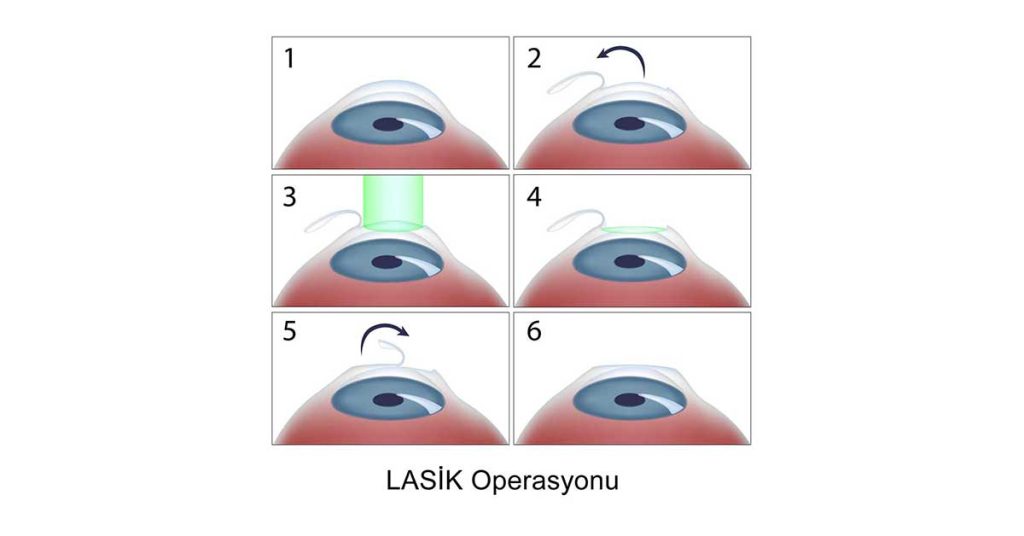 LASIK Lazer Göz Ameliyatı-Göz Çizdirme LASIK Lazer Göz Ameliyatı-Göz Çizdirme