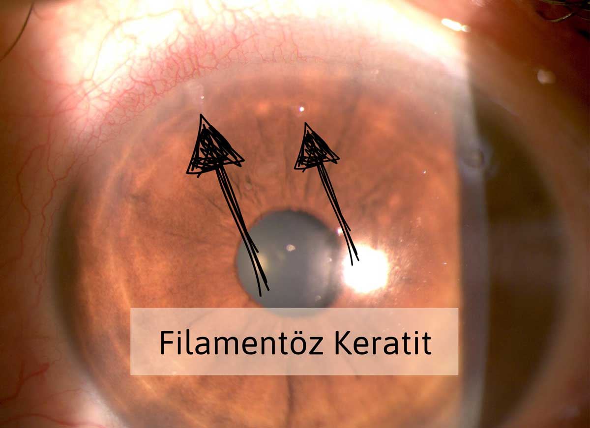 Filamentöz Keratit